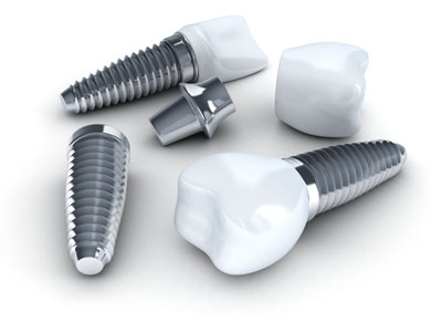 All On Four Procedure &# ; What You Need To Know About Teeth Replacement